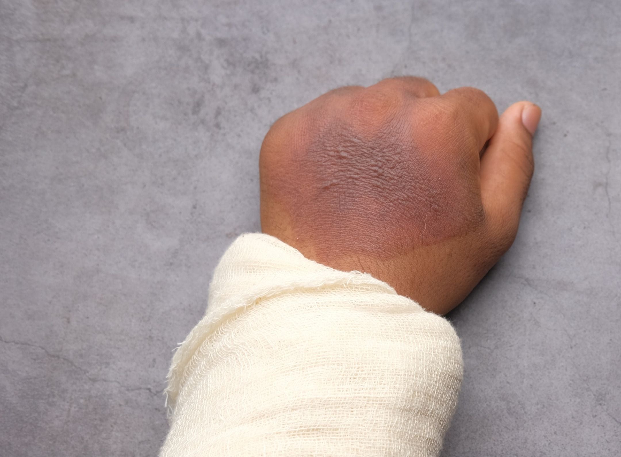 HOW TO CURE SWELLING AFTER INJURY